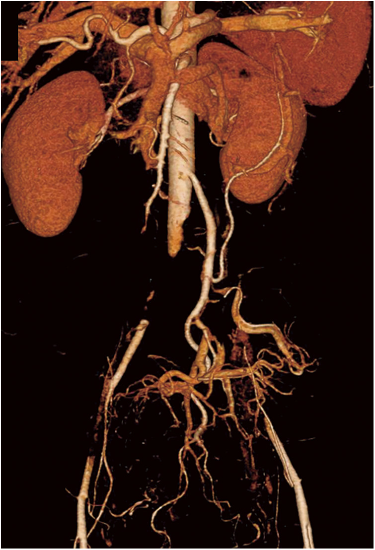 Fig. 1 Computed tomography angiography image showing infrarenal aortic occlusion with extension into both external iliac arteries.