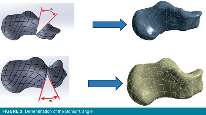 The importance of Böhler’s angle in calcaneus geometry: A finite ...