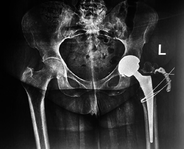 X-ray of a hip joint AI-generated content may be incorrect.