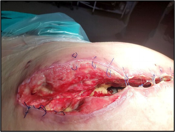 A close-up of a wound AI-generated content may be incorrect.
