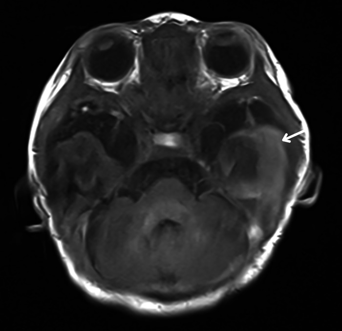 Subpial hemorrhage: A rare and underrecognized site of intracranial ...