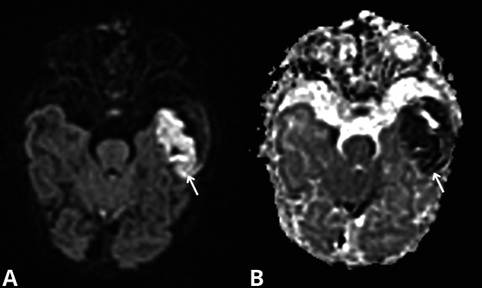 Subpial hemorrhage: A rare and underrecognized site of intracranial ...