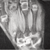<b>Fig. 3</b>: T2 weighted image of MRI showing
hyperintense lesion in capitate along with soft tissue synovitis.