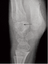 <b>Fig. 2b</b>: Lateral radiographs of wrist
at presentation showing a lytic area in capitate.