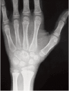 <b>Fig. 4</b>: Plain radiograph at 9 month follow up showing
remineralisation and sclerosis of lesion.