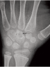 <b>Fig. 2a</b>: AP radiograph at presentation
showing a lytic lesion in capitate.