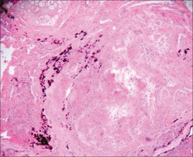 Pulmonary sarcoidosis: An important differential diagnosis in ...