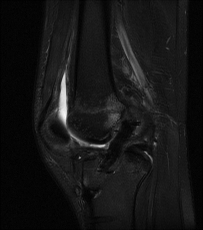 Anterior Cruciate Ligament (ACL) Reconstruction Augmented With Bone ...