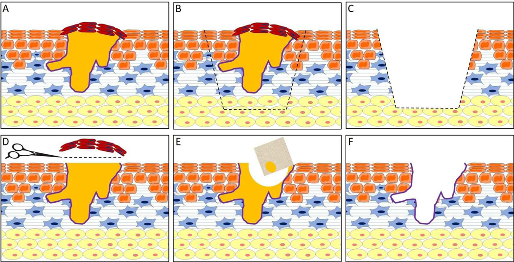 Medical and surgical management of hidradenitis suppurativa: a review ...