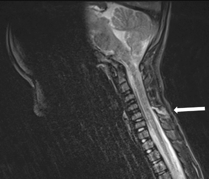 MRI showing C5-C6 interspinous ligament oedema