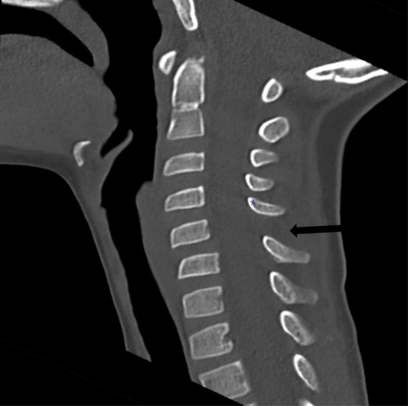 CT-exam revealing C4-C5 anterolisthesis and increase in the interspinous space