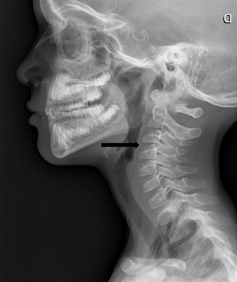 Lateral cervical xray where a discrete C3–C4 dislocation was described