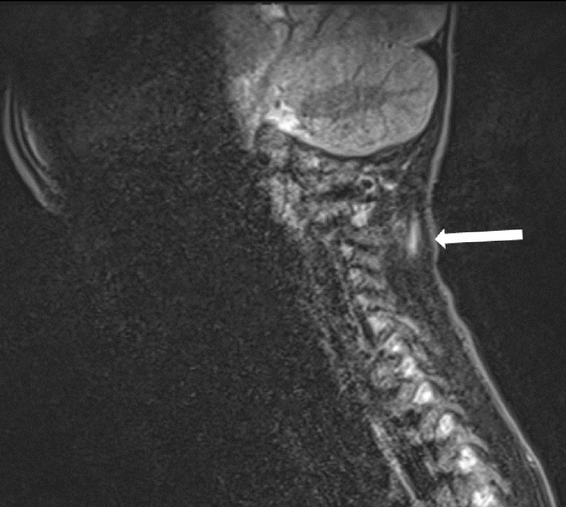 MRI showing left superficial posterior paramedian muscle oedema around C2