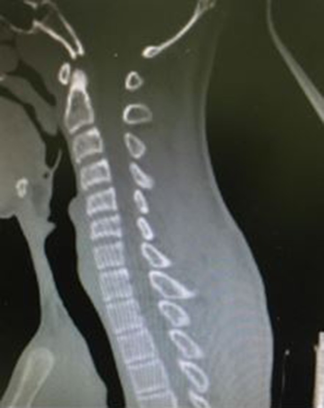 Traumatic cervical spinal cord transection - PMC