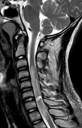 Traumatic cervical spinal cord transection - PMC