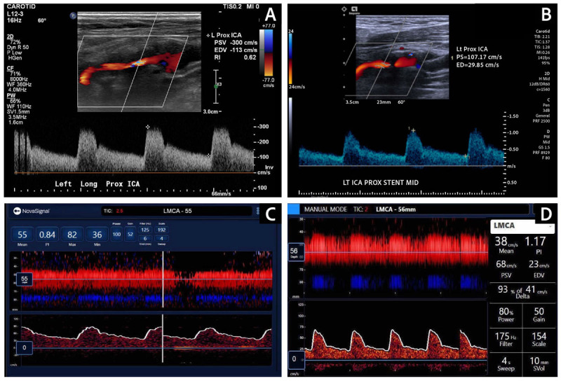 1A Preop ultrasound of severe stenosis in proximal ICA. 1B Postop ultrasound shows good stent patency, normal flow velocities & improved pulse waveforms 1C Preop TCDof blunted left MCA pulse waveform confirms proximal stenosis 1D TCD after stenting shows substantial improvement in systolic upstroke in pulse waveform of left MCA