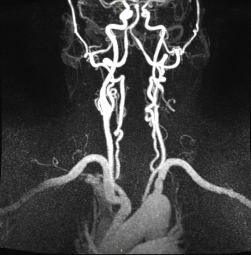 MRA shows 70-80% left internal carotid artery stenosis