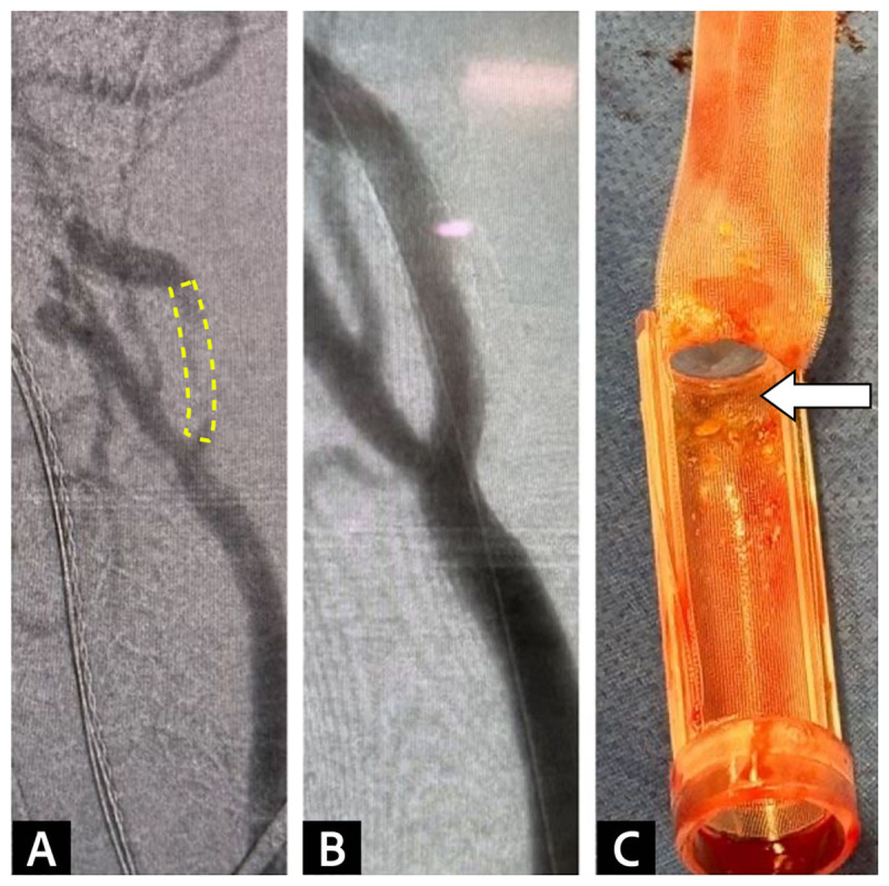 3A Angiogram before stenting shows stenosis in internal carotid artery 3B Post-stenting angiogram confirms stenosis resolution 3C The 200-micron filter integrated into flow reversal system captures embolic debris before reaching venous return sheet