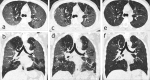 Serial CT scans of a 57-year-old man with severe COVID-19 pneumonia. (a, b) Axial and coronal thin-section CT scans obtained on day 9 after the onset of symptoms showed extensive ground-glass opacities (GGO) and interstitial thickening bilaterally. (c, d) Scans obtained on day 46 showed evolution to a mixed pattern of ground-glass opacities and consolidation with almost the same extent of lesions. (e, f) Scans obtained on day 159 showed a marked decrease in the density of GGO, with a slightly increased extension of the GGO (“tinted” sign or “melting sugar” sign, which defined as an imaging appearance of increased extension of the GGO or consolidation and decreased density).