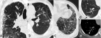 Chest follow-up CT findings of COVID-19 pneumonia: (a) traction bronchiectasis; (b) parenchymal bands; (c) honeycombing; (d, e) thickening of the adjacent pleura.