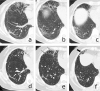 Serial CT scans of a 46-year-old woman with severe COVID-19 pneumonia. (a-c) The scan obtained on day 32 after symptom onset showed multiple ground-glass opacities (GGOs) and interstitial thickening with mild cylindrical traction bronchiectasis involving the middle lobe and lower lobe of the right lung. (d-f) The scan obtained on day 198 showed partial absorption of the abnormalities, reduced extension, traction bronchiectasis (thin arrows) and localized “honeycombing” (thick arrow) in the subpleural region of the right middle lobe.