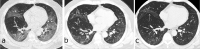 Serial CT scans of a 52-year-old man with severe COVID-19 pneumonia. (a) The axial thin-section CT scan obtained on day 8 after symptom onset showed multiple ground-glass opacities (GGOs) bilaterally, with a slight traction of the right interlobar pleural (arrow). (b, c) Scans obtained on days 79 and 149, respectively, showed continuous absorption of previous opacifications, with the progression of interlobar pleural traction.