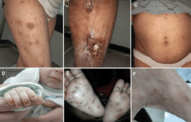 The currently available diagnostic tools and treatments of scabies and ...