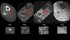 Figure 2 Tibial vessels imaged with CTA and MRI using T1/T2-weighted and ultrashort echo time sequences.