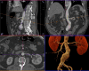 Figure 3 3D multiplanar reconstruction determines aortic neck measurements to size abdominal aortic endograft.