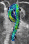 Figure 5 4D flow MRI helps visualize temporal evolution of blood flow patterns within an acquired 3D volume.