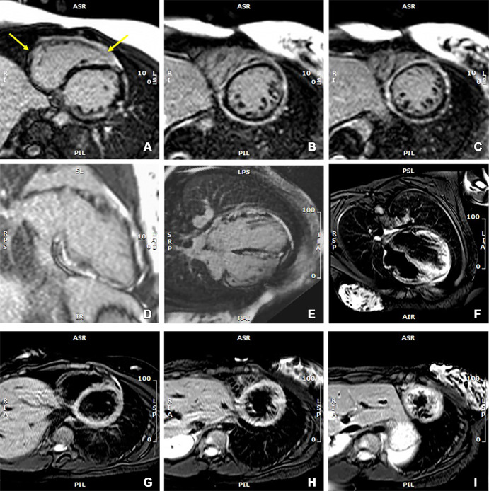 Images from cardiac MRI that were obtained at initial patient presentation when there was a spike in troponin I and NT-proBNP levels. Late gadolinium enhancement (LGE) images in (A–C) short-axis, (D) vertical long-axis, and (E) horizontal long-axis views show diffuse and circumferential LGE in the subepicardial myocardium of the left ventricle and patchy enhancement in the right ventricular myocardium (arrows, A). The images also show patchy and scattered LGE extending into the midmyocardium, which is less intense than the subepicardial enhancement. (F) Horizontal long-axis T2-weighted image and (G–I) short-axis images at three ventricular levels with suppression of blood and fat signals show edema in biventricular myocardium and pericardium that is most visible in the left ventricle. About 55% of the left ventricular myocardium showed LGE in reference to a signal intensity threshold of 5 SDs above the mean in normal myocardium. NT-proBNP = N-terminal pro–B-type natriuretic peptide.