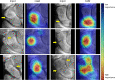 Examples of class activation maps (CAMs) for localizing fractures. The
interpretation of the CAMs is performed on the basis of the color coding of
a heatmap, in which pixel regions with a warm color signify a greater
influence on the final decision of the network than regions with a cold
color. The yellow arrows on the input images indicate the fracture lines,
and they are only shown for reference.