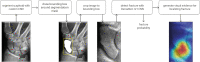 Illustration shows an overview of the scaphoid fracture detection
pipeline, which consists of segmentation and detection convolutional neural
networks (CNN). A class activation map is calculated and visualized as a
heatmap for fracture localization.