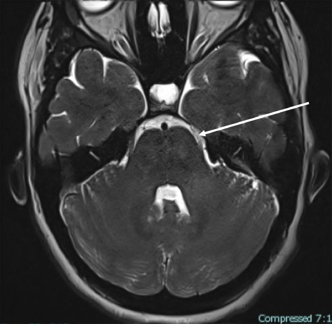 Absent Meckel's cave as a possible cause of trigeminal neuralgia: A ...