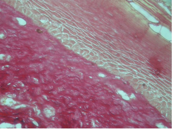 Figure 2: Shows OSMF with atrophic epithelium, constricted blood vessels and perivascular inflammatory infiltrate, collagen deposition around muscle and blood vessel. (H&E stain-20X)