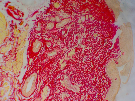 Figure 4: Shows OSMF with predominantly yellowish orange birefringence in the lamina propria. (Picrosirius red stain-10X)