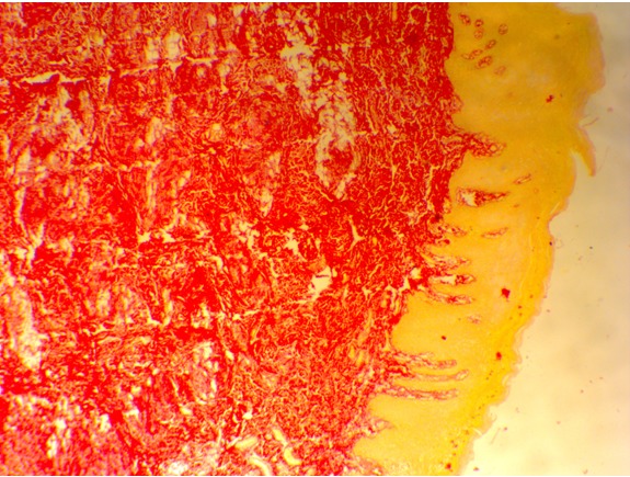 Figure 3: Shows OSMF with predominantly greenish yellow to reddish orange birefringence in the lamina propria. (Picrosirius red stain-10X)