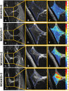 Example images show IPFP texture maps classified into different
severities of Hoffa synovitis using the MRI Osteoarthritis Knee Score
(MOAKS). (A–C) MOAKS = 0, IPFP texture score = –0.6769.
(D–F) MOAKS = 1, IPFP texture score = –0.1758. (G–I)
MOAKS = 2, IPFP texture score = 0.4273. (J–L) MOAKS = 3, IPFP texture
score = 0.9446. Higher IPFP texture scores correspond to more spatial
heterogeneity.