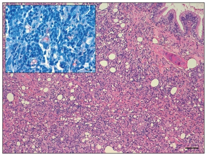 Imaging Of Exogenous Lipoid Pneumonia Simulating Lung Malignancy In A 