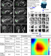 Example of the AI model predicting a Liver Imaging Reporting and Data
System (LI-RADS) other malignancy category (LR-M) focal liver lesion (FLL).
(A–F) Axial gadoxetic acid–enhanced MRI scans show a 16-mm FLL
in a 39-year-old male patient. (A) The FLL was seen as hypointensity on
precontrast T1-weighted image (T1WI). (B) Mild to moderate T2 hyperintensity
was noted. There was (C) rim arterial phase hyperenhancement (APHE), (D)
nonperipheral washout at portal venous phase (PVP), and (D–E)
enhancing capsule at PVP and transitional phase (TP). Ancillary features
such as (E) TP hypointensity (arrow) and (F) hepatobiliary phase (HBP)
hypointensity were noted. Since rim APHE could not be confirmed by reader 1,
this FLL was categorized into LR-M with use of the original LI-RADS version
2018. After accessing five three-dimensional (3D) bounding boxes for each
lesion, the AI model applied a series of intensity projections (IP),
including maximum IP (MAIP), minimum IP (MIIP), and average IP (AVIP), to
each 3D bounding box obtained from precontrast T1-weighted imaging,
T2-weighted imaging (T2WI), AP, PVP, and HBP. Additionally, the median layer
of the phase and the difference between the MAIP and MIIP were calculated as
feature values. As a result, it was recategorized as hepatocellular
carcinoma (HCC) by the lesion classifier with a probability of 0.9992. The
heatmap of the deep learning model analyzing the hepatic nodule indicates
the contribution of the corresponding area to the model prediction (1.00
indicates the region with the most important contribution, while 0 indicates
no contribution). In this case, the feature classifier identified nonrim
APHE with a probability of 0.978, and heterogeneous enhancement (arrows) was
noted after reviewing the (G) coronal precontrast T1-weighted images and (H)
coronal AP images. The presumptive diagnoses were changed to definite HCC.
After surgical resection, it was confirmed as HCC.