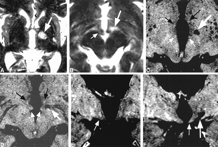 Heavily T2-Weighted MR Imaging of White Matter Tracts in the ...