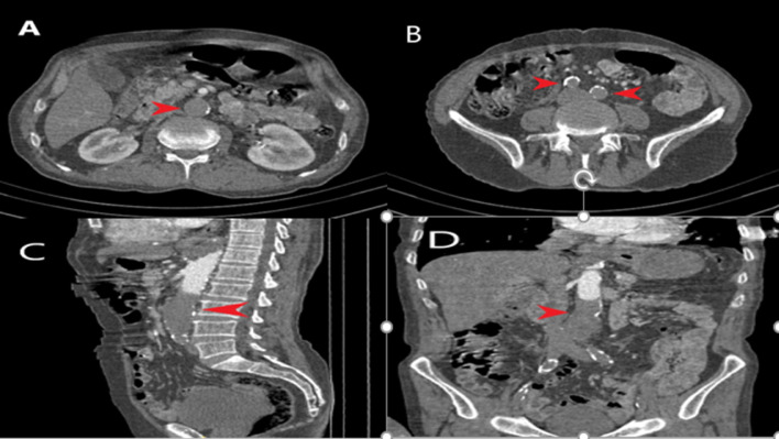 Severe Aortic Thrombosis In The Early Period After Covid-19: Two Cases 