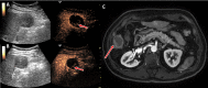 Example of two-dimensional (2D) contrast-enhanced (CE) US and CE MRI
discordance. (A) Transverse 2D dual B-mode (left) and CE US (right) images
obtained 1–2 weeks after transarterial chemoembolization (TACE). (B)
Transverse 2D dual B-mode (left) and CE US (right) images obtained
4–6 weeks after TACE. (C) Axial CE MRI scan obtained 4–6 weeks
after TACE. All images were obtained in a 62-year-old male participant with
a 5.5-cm hepatocellular carcinoma in segment V of the liver that had
residual tumor after TACE, confirmed with re-treatment angiography
(reference standard) after identification of residual disease at imaging
1–2 months after TACE. This example shows CE US and CE MRI
discordance, with CE US readers correctly identifying this lesion as
incompletely treated, while CE MRI readers incorrectly deemed this treatment
complete based on posttreatment inflammatory rim enhancement (arrows). Here,
CE US revealed the success of TACE earlier and more accurately than CE MRI,
with this series demonstrating the high sensitivity of CE US.