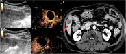 Example of two-dimensional (2D) contrast-enhanced (CE) US and CE MRI
concordance. (A) Transverse 2D dual B-mode (left) and CE US (right) images
obtained 1–2 weeks after transarterial chemoembolization (TACE). (B)
Transverse 2D dual B-mode (left) and CE US (right) images obtained
4–6 weeks after TACE. (C) Axial CE MRI scan obtained 4–6 weeks
after TACE. All images were obtained in a 67-year-old male participant with
a 2.8-cm hepatocellular carcinoma in segment VI of the liver that was
incompletely treated with TACE and that was confirmed when residual
viability was present on the 4–8-month follow-up CE MRI scan
(reference standard). Peripheral enhancement visible on C suggests residual
tumor after TACE, which parallels the enhancement within the tumor on the CE
US scan. This example shows 2D CE US and CE MRI diagnostic concordance,
where readers for both modalities deemed this lesion incompletely treated
based on arterial phase hyperenhancement (arrows). Here, CE US was used
effectively to determine post-TACE viability earlier than with CE MRI, which
ultimately yielded the same result.