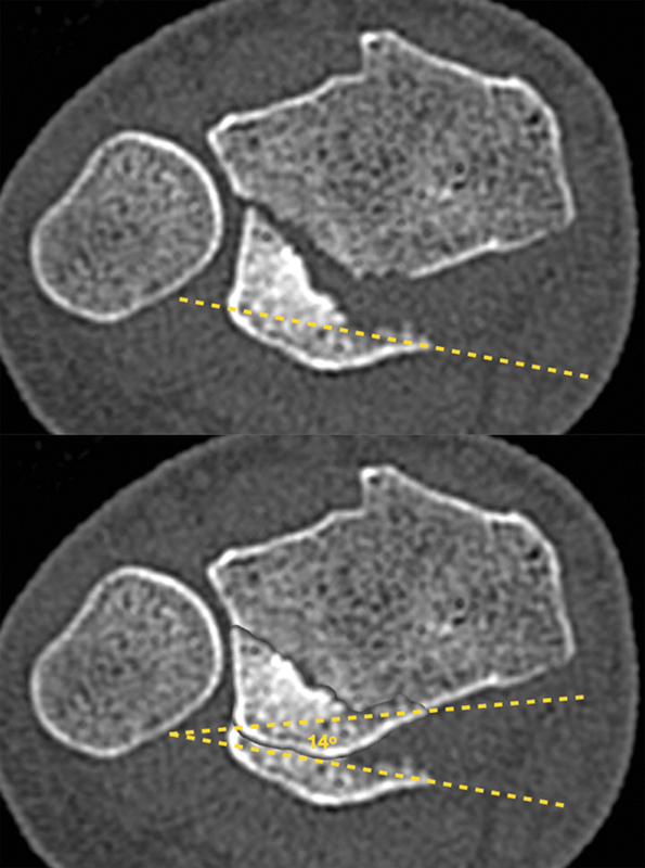 Volar Lunate Facet Fractures of the Distal Radius: Fracture Mapping ...