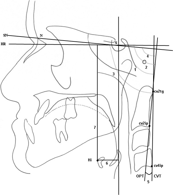 Figure 2. Craniocervical and hyoidal measurements. (1) SN.OPT. (2) SN.CVT. (3) OPT.HR. (4) CVT.HR. (5) OPT.CVT. (6) Hi-VR. (7) Hi-HR.