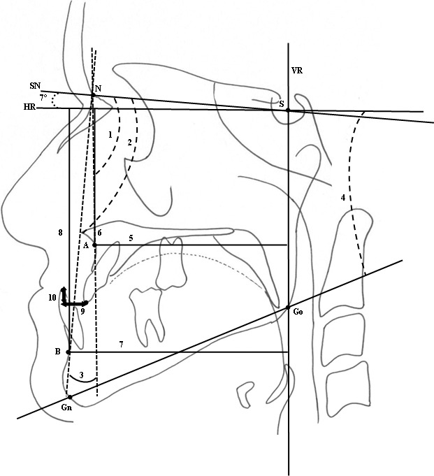 Figure 1. Skeletal measurements. (1) SNA. (2) SNB. (3) ANB. (4) GoGnSN. (5) A-VR. (6) A-HR. (7) B-VR. (8) B-HR. Dental measurements. (9) Overjet. (10) Overbite.