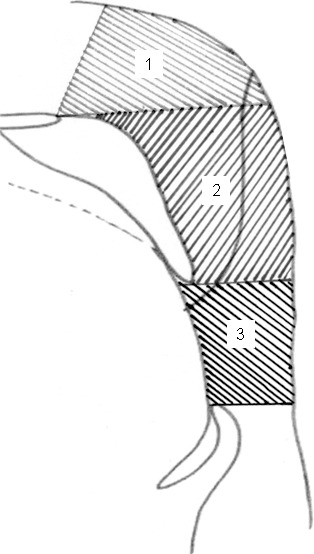 Figure 4. Pharyngeal area measurements. (1) Nasopharynx. (2) Oropharynx. (3) Hypopharynx.