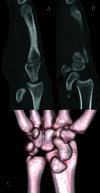Figure 3 A. Sagittal view of the radiocarpal dislocation B. Sagittal view
of the avulsion fractures (arrows) C. Volume-rendered 3D image.