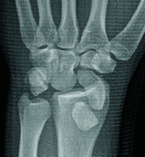Figure 1 X-ray Frontal view.